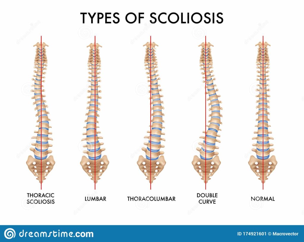 types of scoliosis